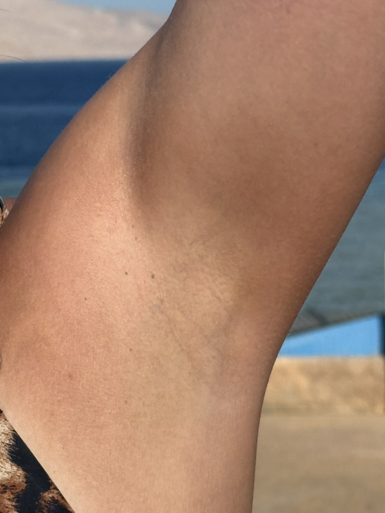 Látványos eredmény lézeres szőrtelenítés után az Eden Laser Lounge-ban